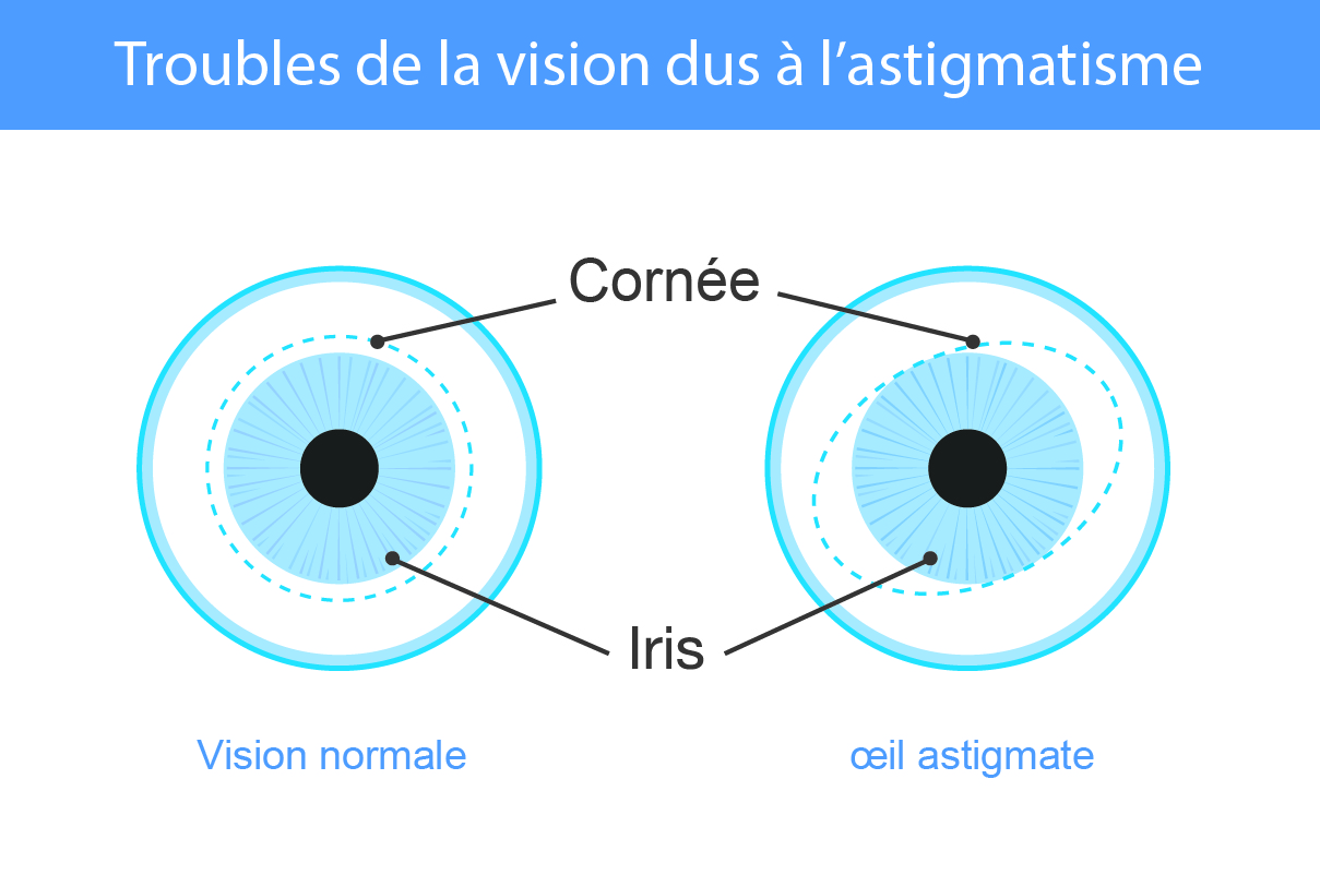 Astigmatisme Association canadienne des optométristes — free download